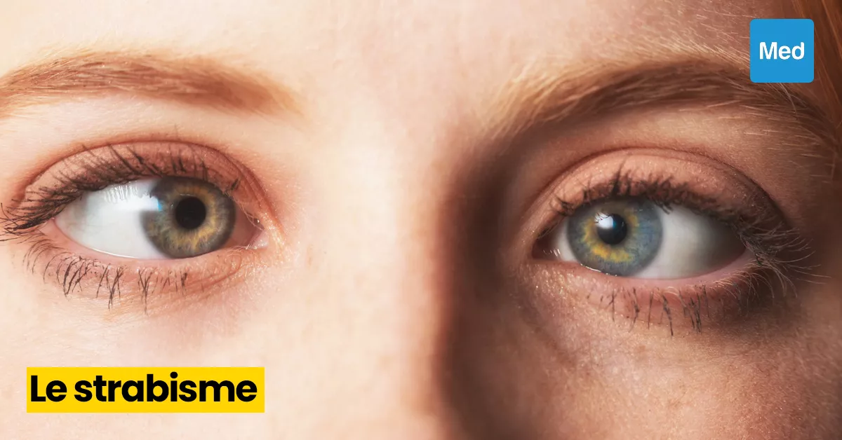 Le strabisme : un trouble oculaire qui mérite d'être pris au sérieux